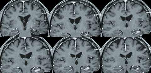 Námi zjištěné neuropsychologické zlepšení po operaci u nemocných primárně léčených GKRS může být důsledkem vymizení záchvatů, a tedy zlepšení funkce kontralaterálních meziotemporálních struktur, pro