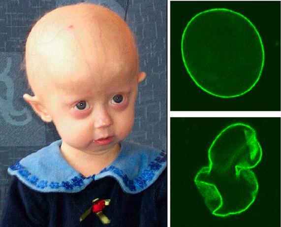 wt HGPS Hutchinson-Gilfordův progeria-syndrom je onemocnění dětí způsobené mutací proteinu významného pro architekturu jádra: aberantní morfologie.