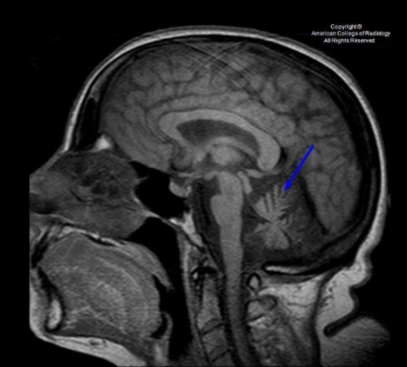 T1-weighted sagittal MR image reveals age-accelerated cerebellar atrophy (arrow, out of proportion to cerebral atrophy) as well as volume loss throughout much of