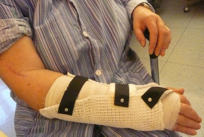 před i po transferu. Často se ale stává, ţe ho vidí 1 aţ 2 týdny po operaci, kdy se mění sádrová fixace za termoplastickou dlahu na další 2-3 týdny pro ochranu transferovaných šlach (obr.