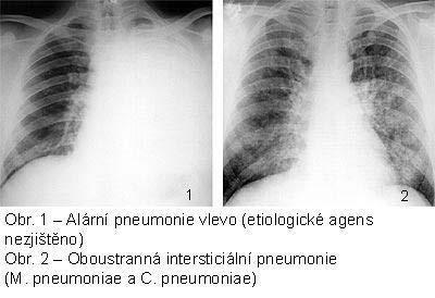 Klinický obraz Typická pneumonie Zánět bronchiolů a alveolů s tvorbou exsudátu, postižení celého laloku (lobární pneumonie), segmentu (segmentální nebo lobulární pneumonie), přestup z bronchů