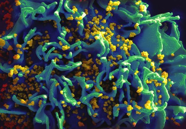 HIV False-colored scanning electron micrograph of HIV