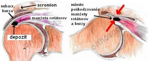 Obrázek 6. Impingement syndrom (Zahradník, 2013). 5.3 Artróza akromioklavikulárního skloubení Artróza je degenerativní, primárně nezánětlivé onemocnění kloubů s destrukcí kloubní chrupavky.