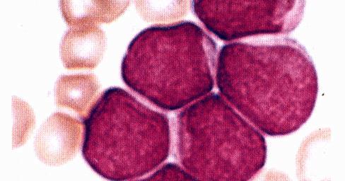 MLL Golub, T.R., et al.