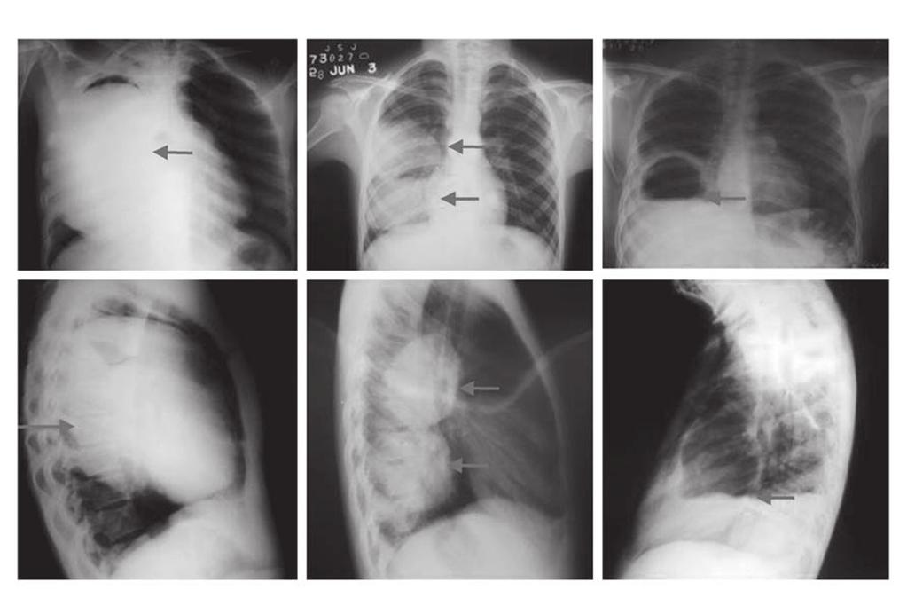 Radiologická diagnostika První krok v rámci detekce a posouzení cyst vzniklých při plicní cystické echinokokóze představují radiologická vyšetření.