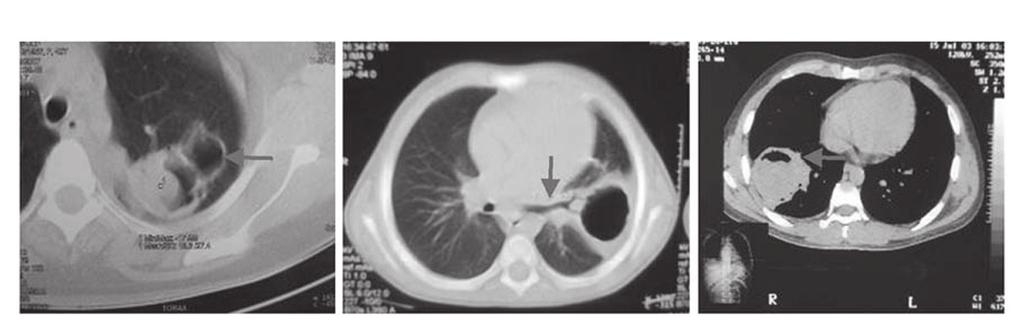 Obrázek 4 Zobrazení za pomoci výpočetní tomografie u komplikované plicní cystické echinokokózy cysty v horním laloku se znamením masy uvnitř dutiny ; prasklá cysta lokalizovaná v zadní části levého