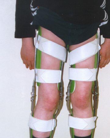 X-vázaná recesivní dědičnost - příklady Duchennova muskulární dystrofie - porucha genu pro dystrofin (svalový protein) svalová slabost (nejprve v oblasti nohou a pánve, méně u svalů paží, krku a
