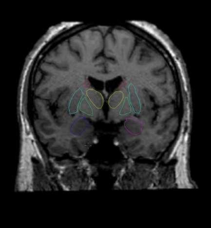 thalamus a amygdala
