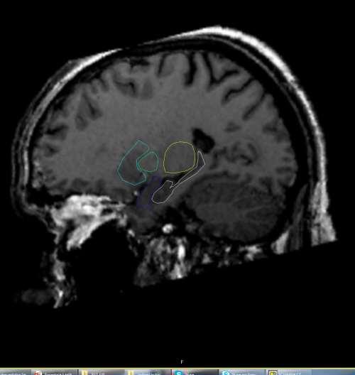 MR SAGITÁLNÍ rovina basální ganglia,