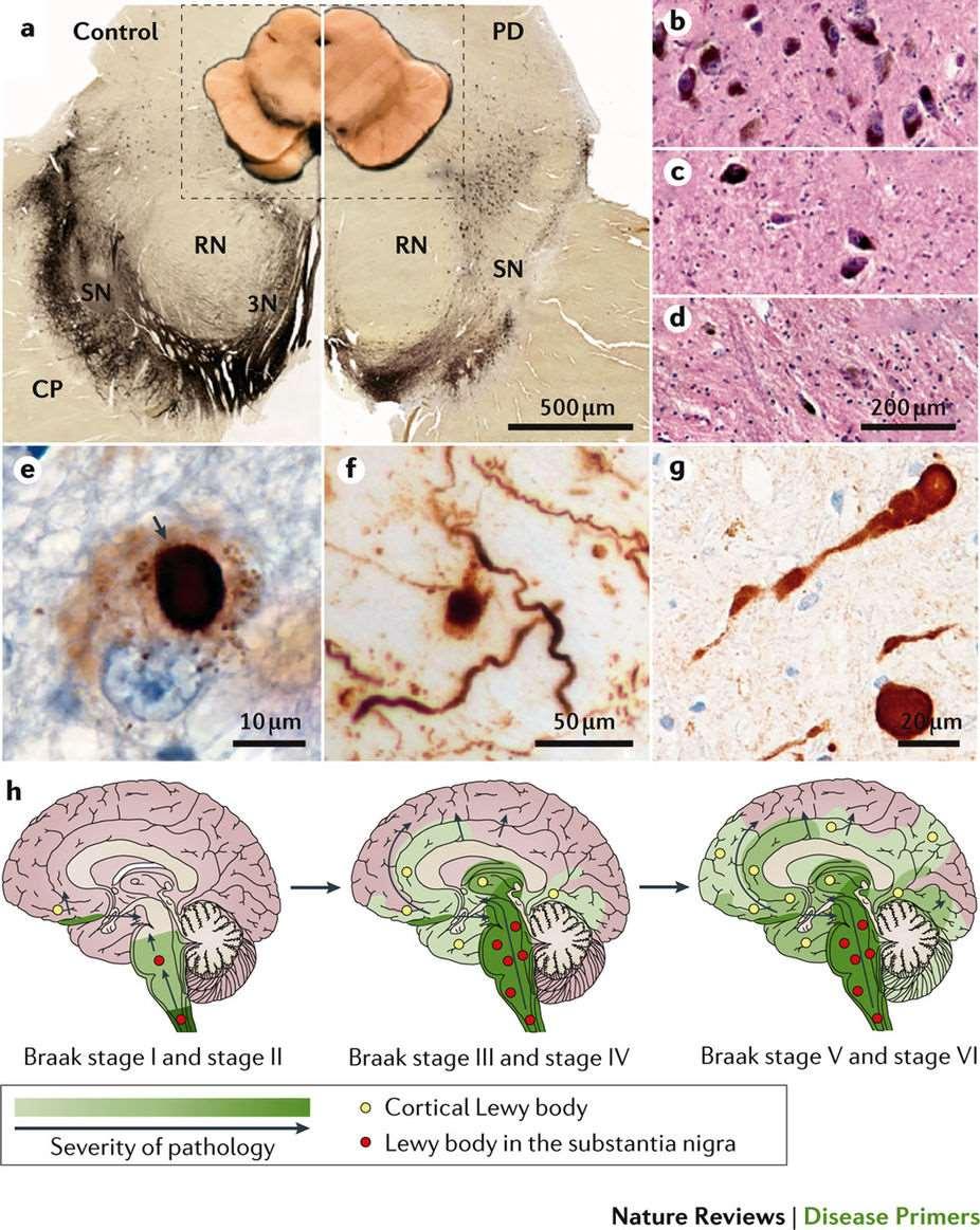 Parkinsonova choroba (PD) a) depigmentace substantia nigra (SN) immunohistochemický průkaz tyrosin hydroxylázy,.