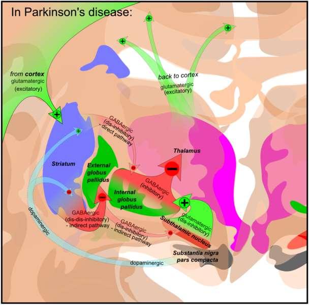 Změny při Parkinsonově chorobě -hypokineze kůra D2 Striatum D1 Thalamus Dopamin SN Pa ext Pa int SN