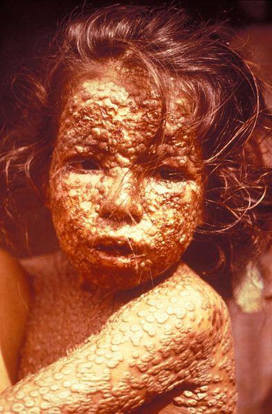 Neštovice velké epidemie 1520 1527 Střední a Jižní Amerika na kontinent zavlečeno Evropany v dubnu 1520 v Tenochtitlanu dřív, než Cortes obětí epidemie byl i incký vládce Huayna Capac (1464 1527)