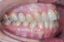 treated with fixed appliances, results in an increased risk of dental carries and sensitivity.