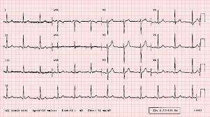 EKG: SR RTG hrudníka bez pozoruhodností CDUS 22/6 : hlboká žilová trombóza 1 vetvy zdvojenej