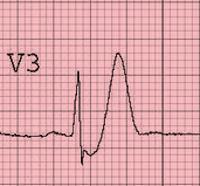 Netypické EKG pri AIM alebo STEMI ekvivalenty Pre akútny uzáver koronárnej tepny (STEMI) môžu svedčať aj netypické zmeny na EKG: - difúzne ST depresie - ST elevácie v avr - DeWinterove T vlny