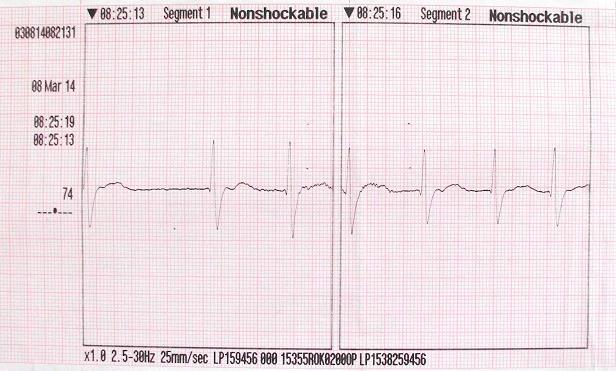 2. analýza srdcového rytmu GCS 3 DF 12/min, SpO 2 99 % TK