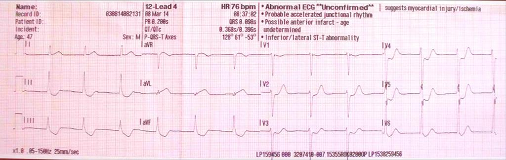 EKG záznam pri odovzdaní posádke RLP akcelerovaný junkčný rytmus, frekvencie 78/min, ST depresia II,
