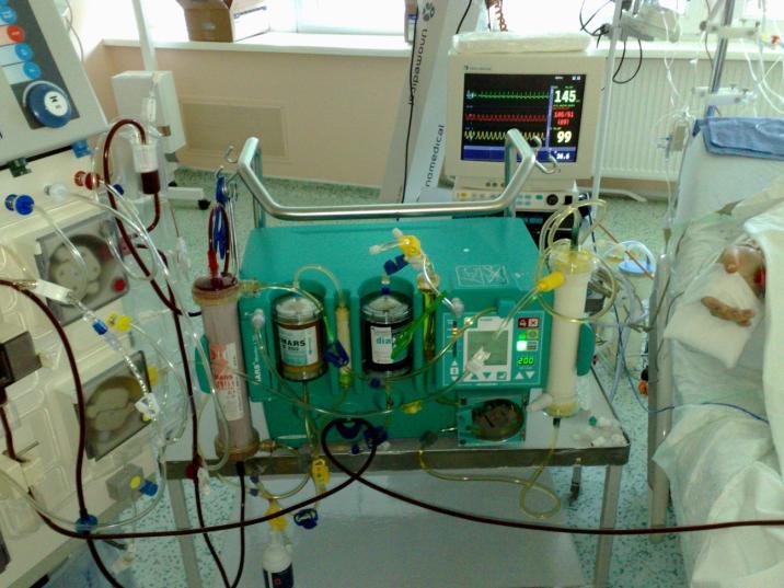 Zlyhanie pečene 4.deň (14.9.2009) akútna ischemická hepatitída ťažkého stupňa až hepatálna insuficiencia spôsobená šokom pri embolizácii do AP, bez evidentnej vaskulárnej obštrukcie hepatal.