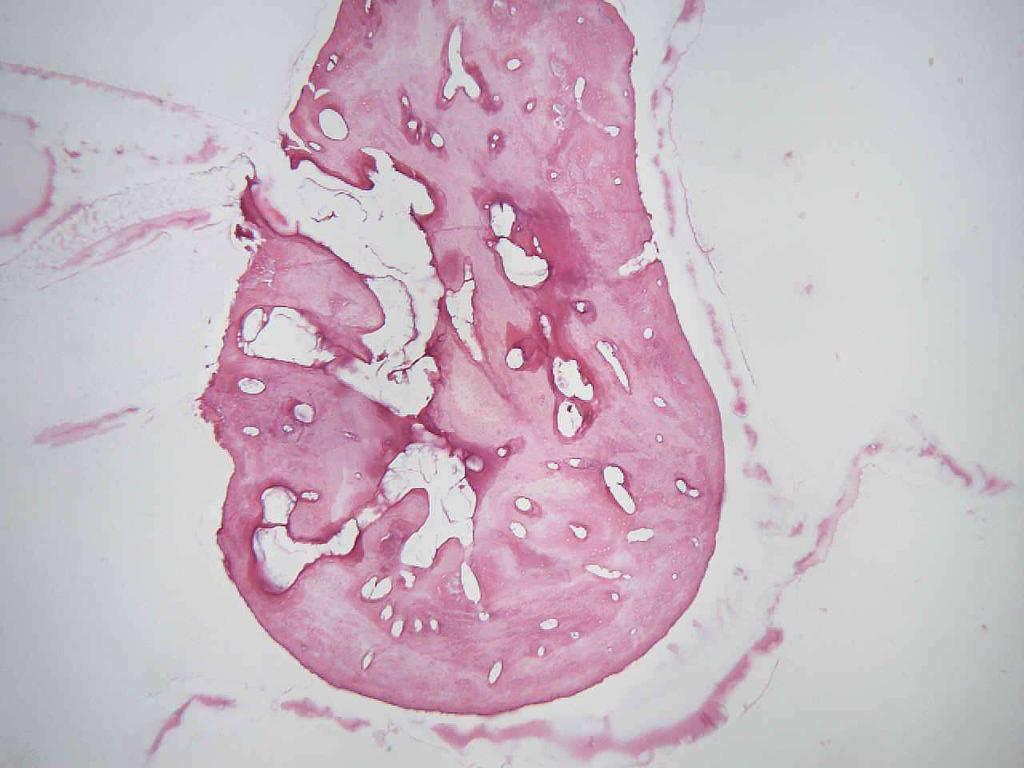 Obr. 13 Histologický řez tělem kovadlinky po mechanickém ošetření a autoklávování. Povrch kovadlinky je zbaven epitelu, dřeňové prostory jsou bez lymfocytární infiltrace.