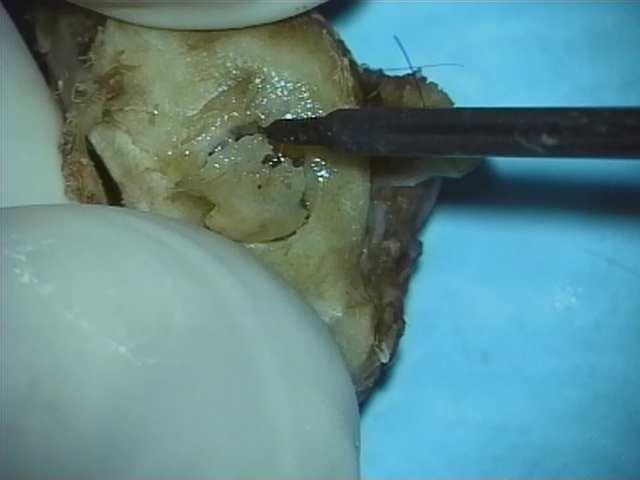Reparační změny bubínku a kosti tympanické buly Při operačním výkonu byl vytvořen otvor ve spodní kostěné stěně tympanické buly o rozměru 3 x 3 mm.