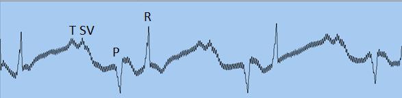 QT (ms) Q S T Had1-0.14 147 353 0.22 80 653 0.0 0.