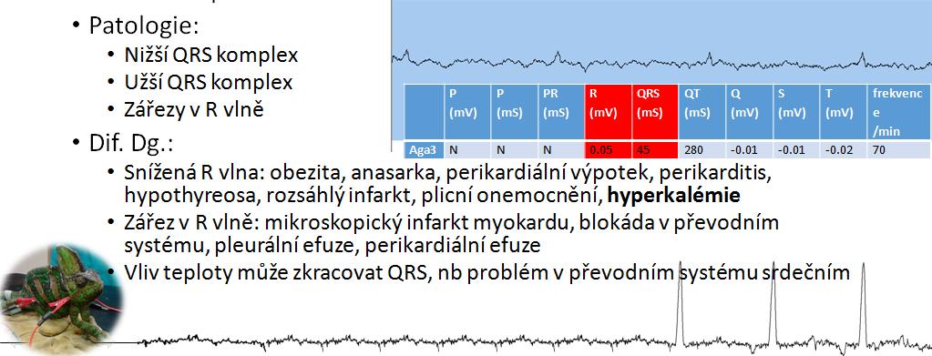 výchylka po R vlně zvýšení amplitudy naznačuje kardiomegalii vliv teploty na délku QRS komplexu zářez v R
