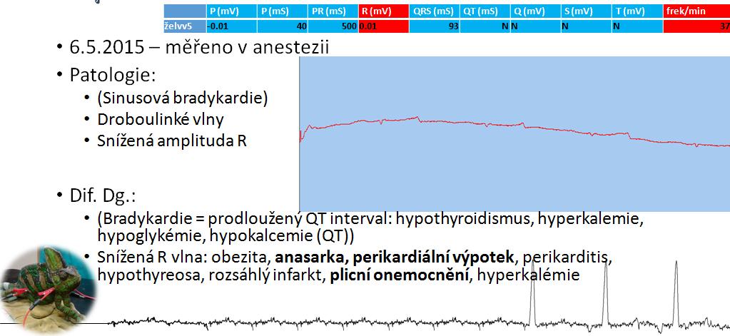 4) Problém ve VLNĚ T Výchylka T vlny může být pozitivní,