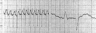 Obr. 41: EKG záznam u ptáka P pulmonale (Převzato z Ritchie a kol., 1994:, úprava: A. Zemanová) Široká hypertrofie levé síně = P mitrale (Obr. 42) Obr.