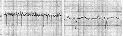 Můžeme vidět tzv. Ta vlnu repolarizace atrií (u holubů, některých papoušků ) Neznamená hypertrofii pravé síně jako u psa!! Obr. 44: EKG záznam u ptáka zkrácený PR interval (Převzato z Ritchie a kol.