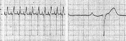 Obr. 46: EKG záznam u ptáka široký a vysoký QRS komplex (Převzato z Ritchie a kol., 1994:, úprava: A.
