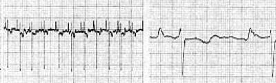 Obr. 48: EKG záznam u ptáka změněná polarizace T vlny (Převzato z Ritchie a kol., 1994:, úprava: A.