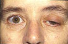 svaly očí (diplopia) a očních víček (asymetrická ptóza), faciální a žvýkací svaly nejvíce postiženy Myastenická krize -poruchy dýchání genetická predispozice 200-400 pacientů na 1 mil. lidí 2.