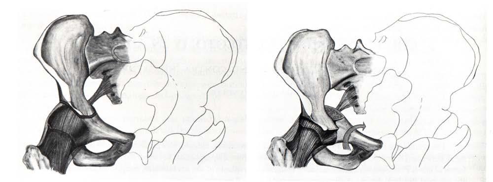Osteotomie pánve