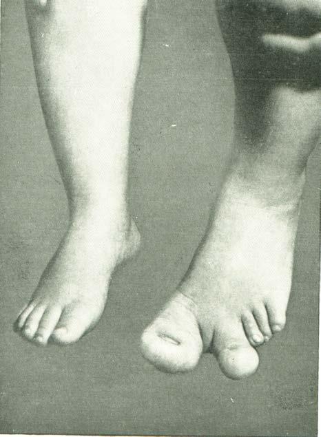 Gigantismus palce a
