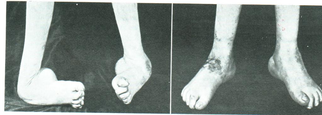Pes equinovarus