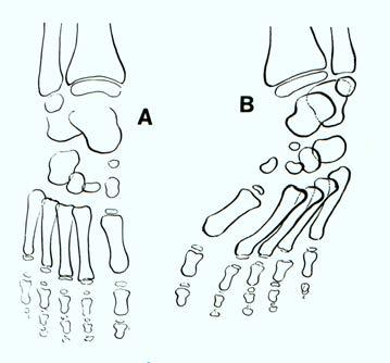 Metatarsus varus congenitus