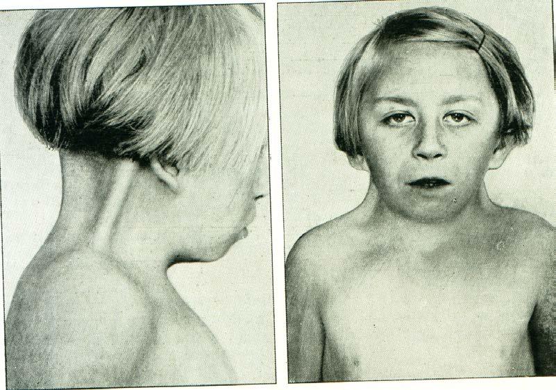 Pterygium