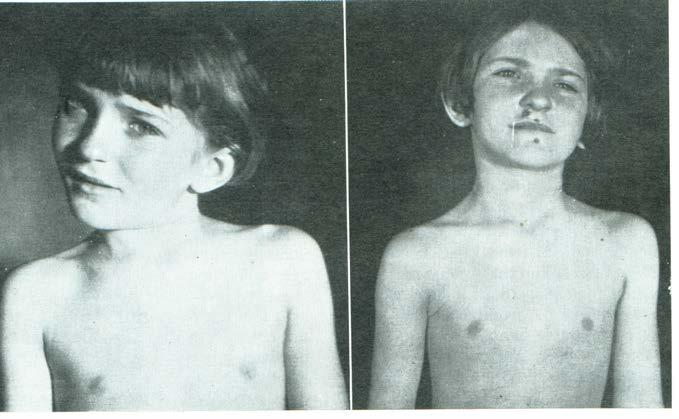 Torticollis muscularis congenita Obr. 39 Porodní trauma m.