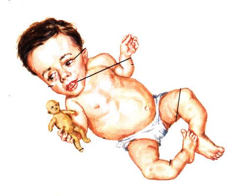 Osteogenesis imperfecta - letalis (mnohočetné
