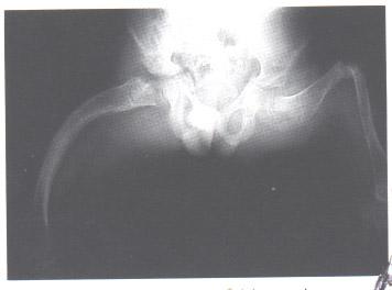 Osteogenesis