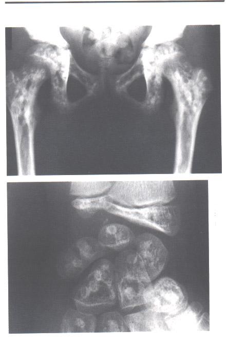 47 Osteopetrosis Kost