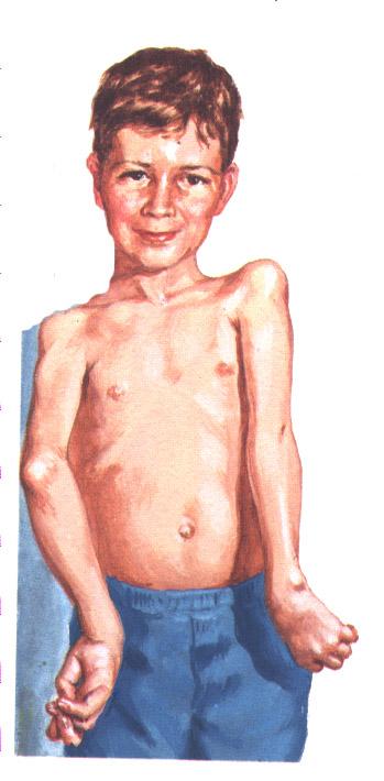 Arthrogyphosis congenita Obr.