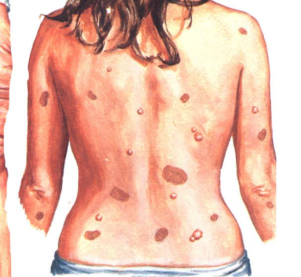 Neurofibromatosis Mnohočetné neurofibromy Skvrny bílé