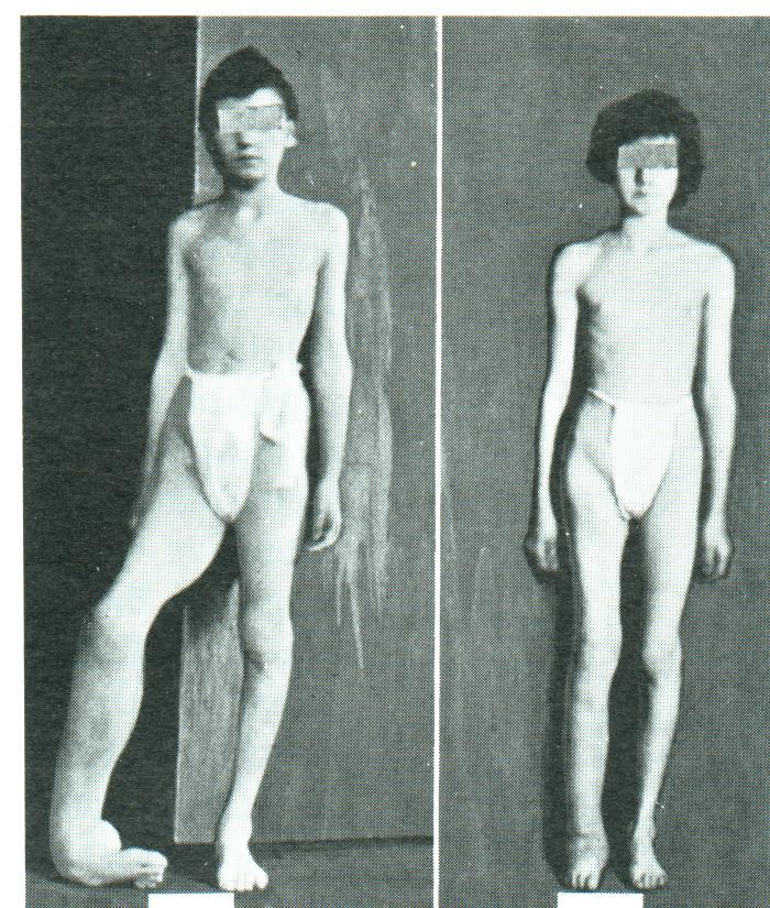 Neurofibromatosis Edémy Elefantiasis