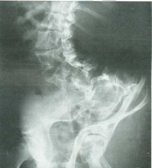 Neurofibromatosis Durální cysty v intervertebrálních