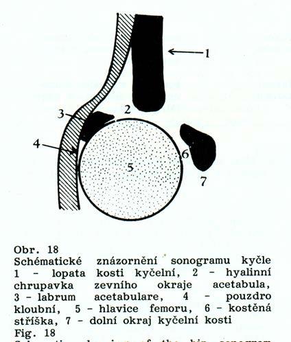 Ultrasonografické vyšetření Klasifikace dle Grafa 1a 1b II a II b II c II d III a III b IV Obr.