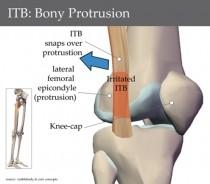 Diferenciální diagnostika Bursitis trochanterica Trp v m. GMe, m.