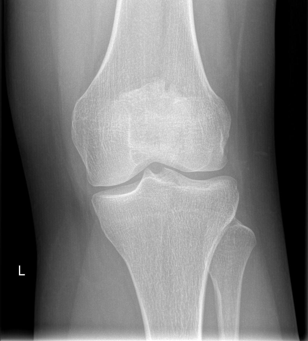 PŘÍLOHY Příloha 1: Rentgenový snímek kolenního kloubu AP