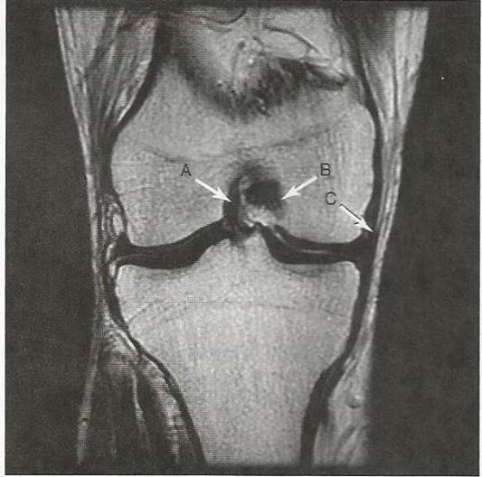 Příloha 6: Snímek z magnetické rezonance koronární řez A - ACL (přední zkřížený