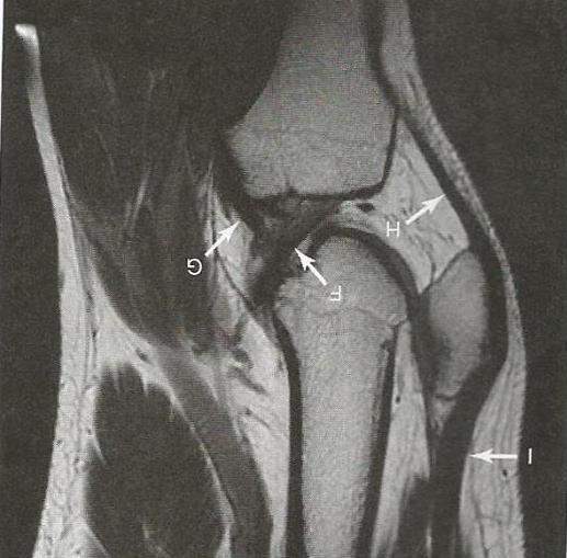 Příloha 7: Snímek z magnetické rezonance sagitální řez F - ACL (přední zkřížený